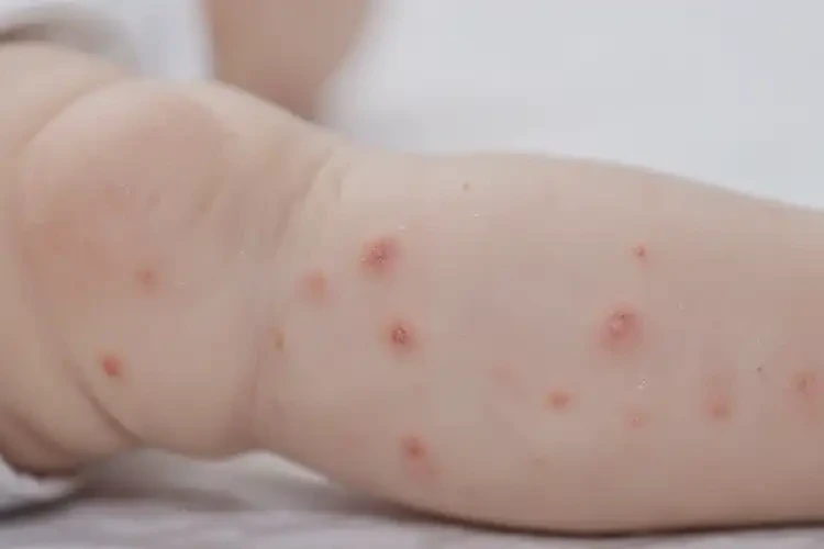 宝宝小腿上容易长湿疹不管它会自己痊愈吗(图4)