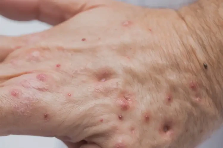 男人手上偶爾起濕疹能不能徹底自愈(圖4)