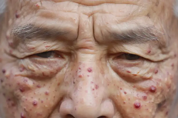 老人面部經(jīng)常起濕疹可以徹底自愈嗎(圖4)