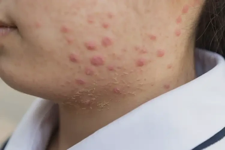 中學(xué)生脖子上容易起濕疹不管它會(huì)自己自愈嗎(圖4)