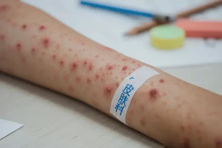 小學(xué)生手臂上長(zhǎng)濕疹不管它會(huì)自己痊愈嗎(圖4)