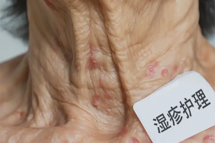 老年人脖子出现湿疹可以彻底自愈吗(图4)