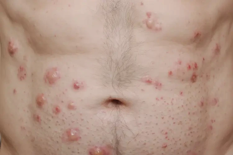 男人肚子經(jīng)常長濕疹不管它會(huì)自己痊愈嗎(圖4)