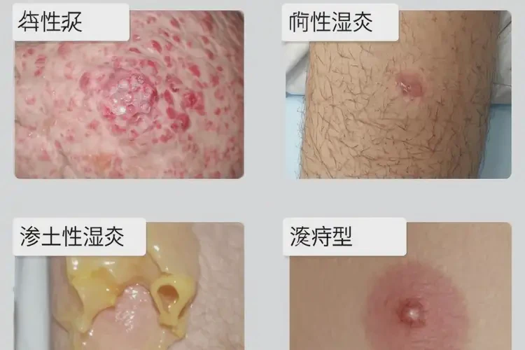 女生大腿上有湿疹不管它会自己自愈吗(图1)