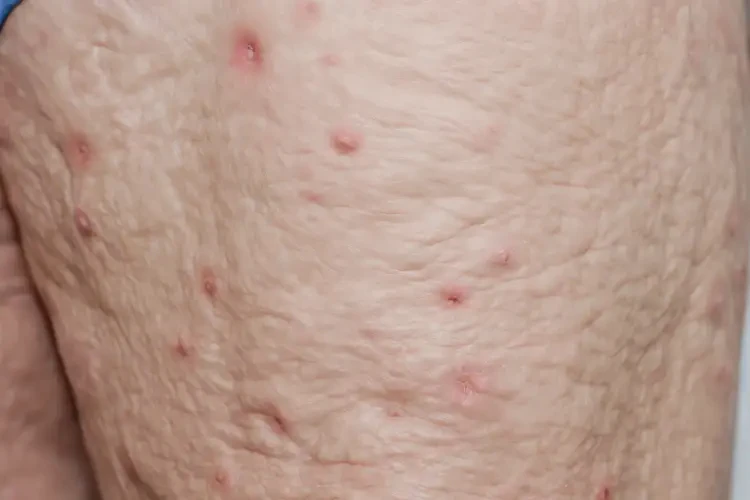 老年人大腿上偶爾長(zhǎng)濕疹不管它會(huì)自己痊愈嗎(圖1)