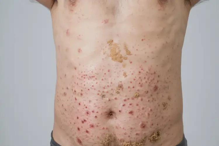 青年人肚子上偶爾長濕疹可不可以徹底自愈(圖2)