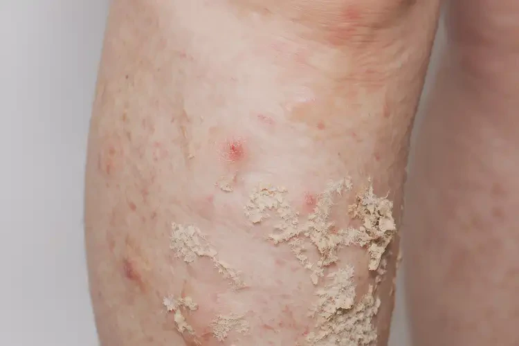 少兒小腿上起濕疹不管它會自己痊愈嗎(圖3)