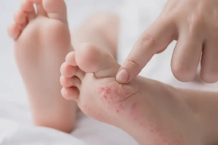 少兒腳上偶爾長濕疹可不可以徹底自愈(圖4)