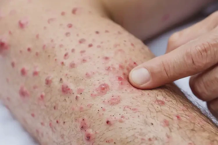 男生四肢長濕疹不管它會自己自愈嗎(圖4)