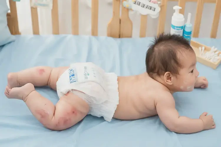 嬰兒屁股偶爾長濕疹能徹底自愈嗎(圖3)