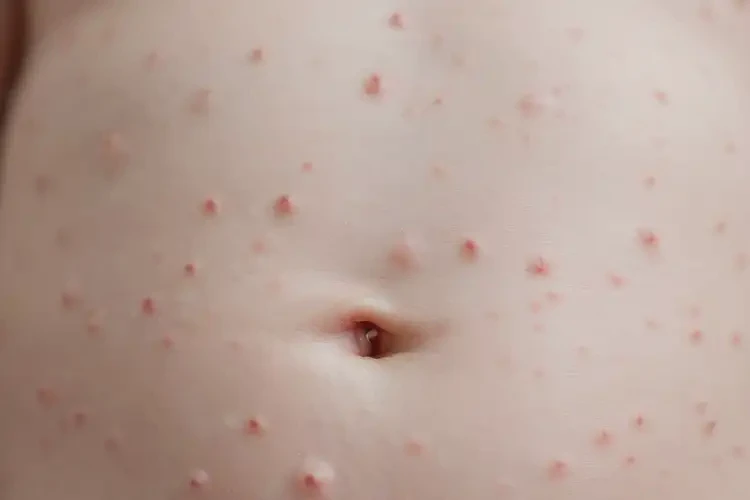 新生兒肚子出濕疹可以徹底自愈嗎(圖4)