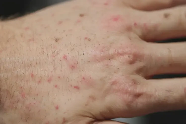 男人手上偶爾長濕疹不管它會自己自愈嗎(圖4)