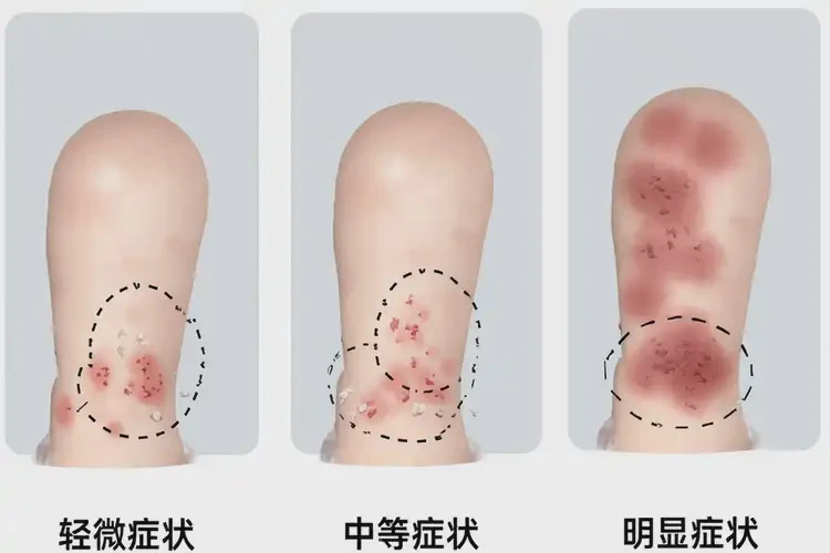 新生兒小腿偶爾起濕疹可不可以徹底自愈(圖1)