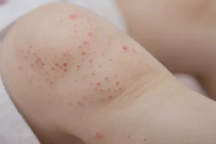 少兒小腿上容易起濕疹不管它會自己好嗎(圖4)