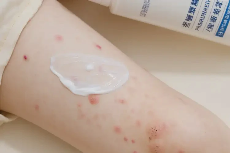 小兒小腿上偶爾起濕疹不管它會自己自愈嗎(圖3)