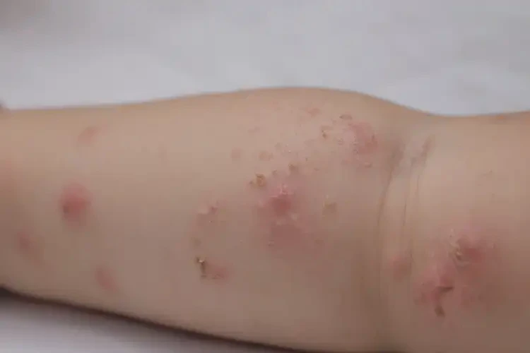 幼兒手臂容易起濕疹不管它會自己好嗎(圖4)