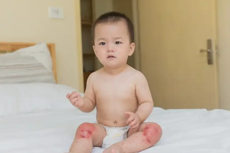 少兒大腿有濕疹不管它會自己痊愈嗎(圖3)