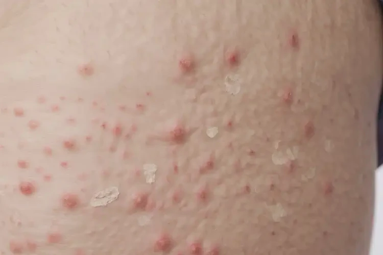 老年人屁股出濕疹可以徹底自愈嗎(圖4)