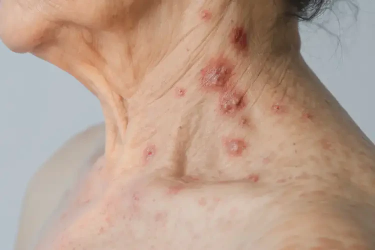 女性脖子上偶爾起濕疹能徹底自愈嗎(圖4)