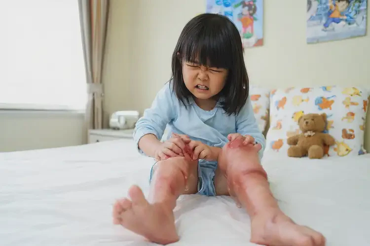 少兒大腿有濕疹不管它會自己痊愈嗎(圖2)