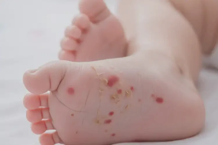 嬰兒腳上起濕疹能徹底自愈嗎(圖4)