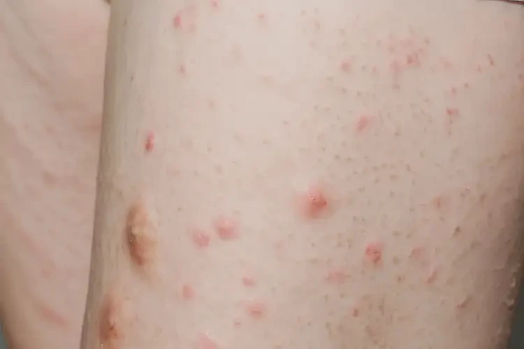 青少年大腿容易起濕疹可不可以徹底自愈(圖4)