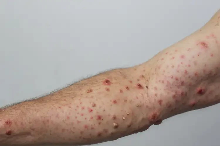 男人身上起湿疹不管它会自己好吗(图4)