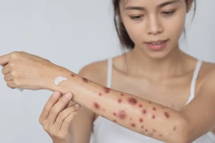 女生手臂出現濕疹能靠自己自愈嗎(圖3)