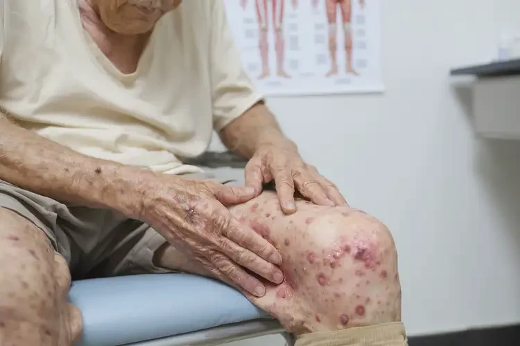 老人大腿上經(jīng)常起濕疹可不可以徹底自愈(圖4)