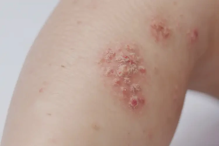 兒童小腿上經(jīng)常起濕疹不管它會(huì)自己好嗎(圖3)