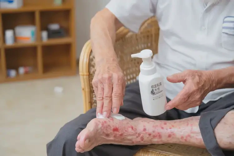 高齡老人小腿上長(zhǎng)濕疹能夠徹底治愈嗎(圖4)