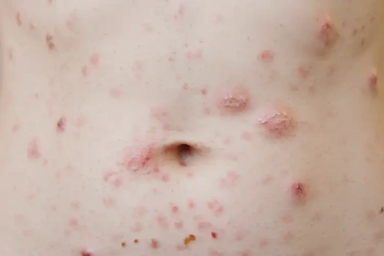 中學(xué)生肚子容易起濕疹能夠徹底治愈嗎(圖3)