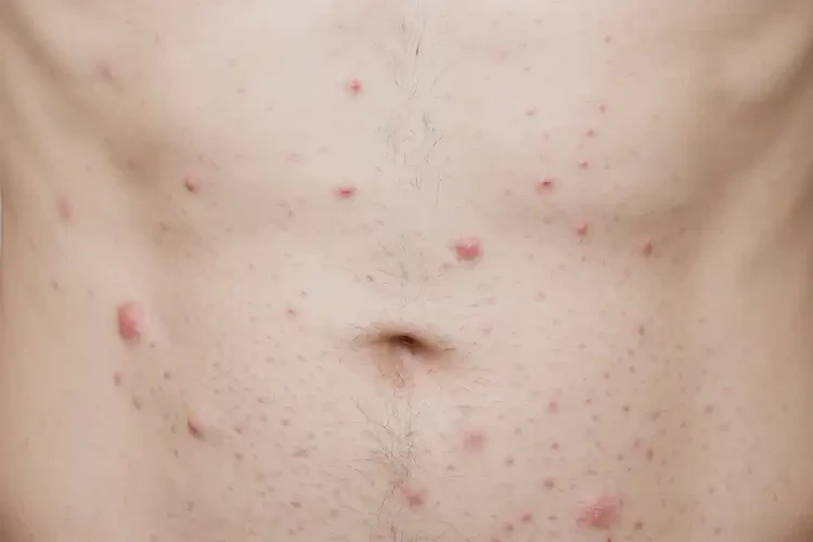 青年人肚子偶爾長濕疹不管它會自己痊愈嗎(圖4)