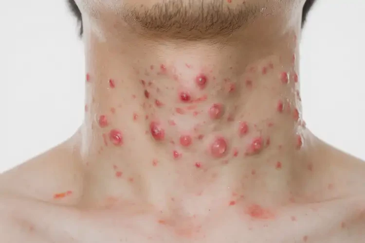 男生脖子偶爾起濕疹可不可以徹底自愈(圖3)