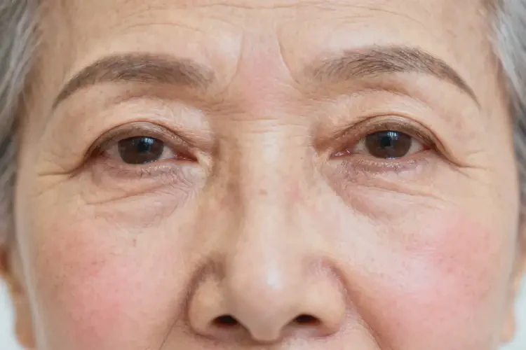 老年人臉上有濕疹能不能徹底自愈(圖1)