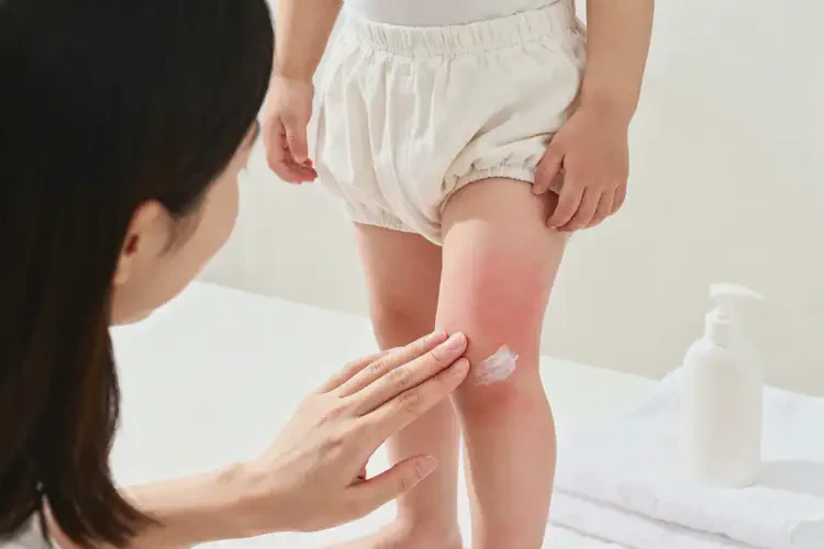 小兒大腿上有濕疹能夠徹底治愈嗎(圖4)