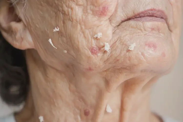 老年人脖子上容易起濕疹能徹底自愈嗎(圖4)