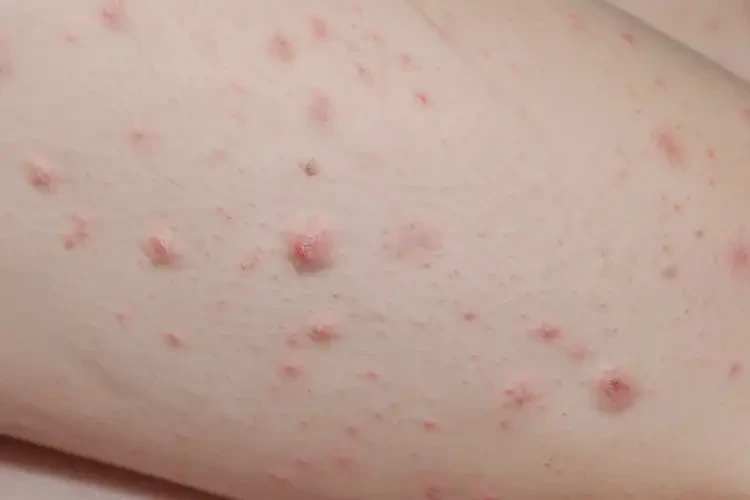 兒童大腿上出濕疹能夠徹底治愈嗎(圖4)