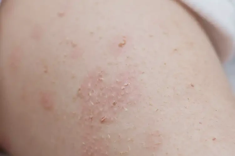 婴幼儿小腿上偶尔长湿疹不管它会自己自愈吗(图4)