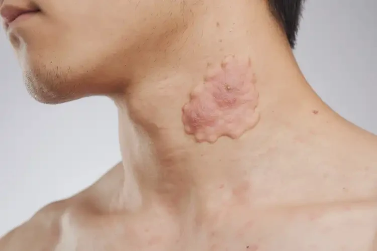 男生脖子有濕疹可以徹底自愈嗎(圖4)