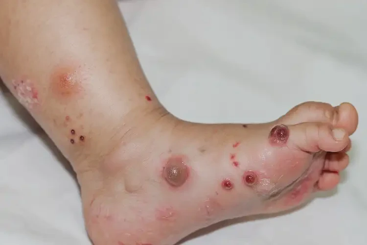 小孩腳上起濕疹可不可以徹底自愈(圖4)