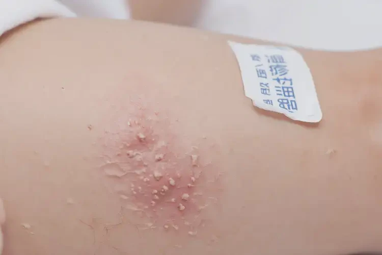 小兒小腿出濕疹可以徹底自愈嗎(圖4)