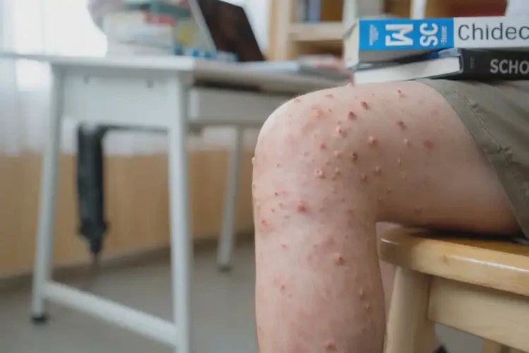 大學生小腿容易長濕疹不管它會自己痊愈嗎(圖2)