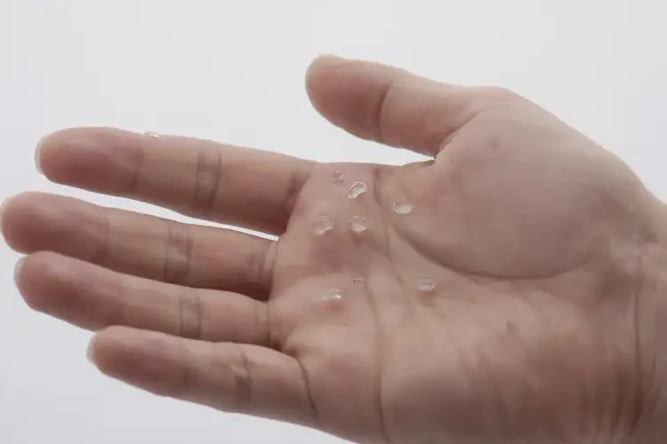 男人手上偶爾長濕疹不管它會自己自愈嗎(圖2)