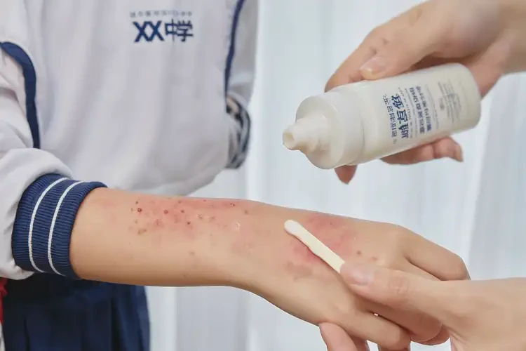 中學(xué)生手上有濕疹不管它會(huì)自己自愈嗎(圖3)