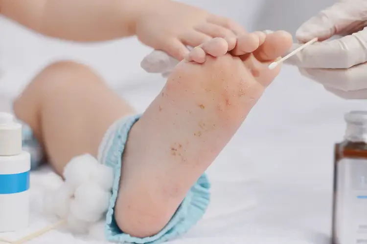 小孩腳上起濕疹可不可以徹底自愈(圖1)