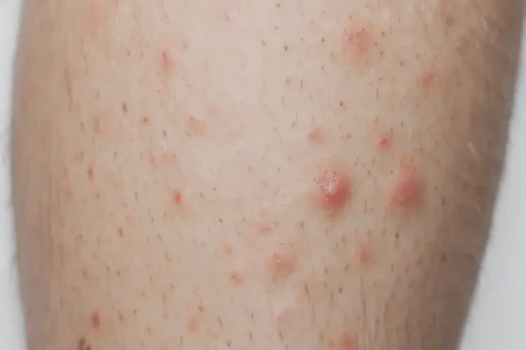 青年人小腿上容易起濕疹不管它會(huì)自己自愈嗎(圖4)