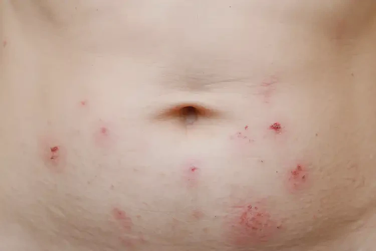 產(chǎn)婦肚子容易長(zhǎng)濕疹不管它會(huì)自己自愈嗎(圖4)