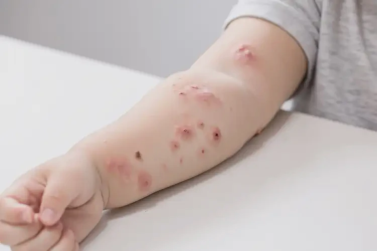 小兒手臂上容易起濕疹不管它會自己自愈嗎(圖3)