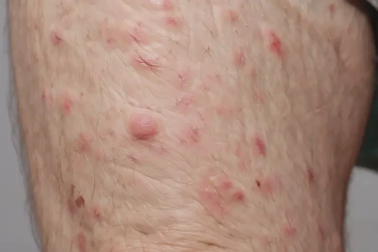 老年人大腿上偶爾長(zhǎng)濕疹不管它會(huì)自己痊愈嗎(圖4)